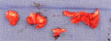 Chondral fragments from comminuted patella fractur