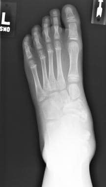 Anteroposterior view of left foot. Medial ankle an
