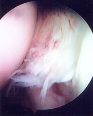 Arthroscopic examination of a patient with recurre