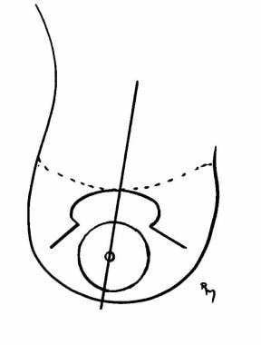 Keyhole positioning on the axis of the breast at t