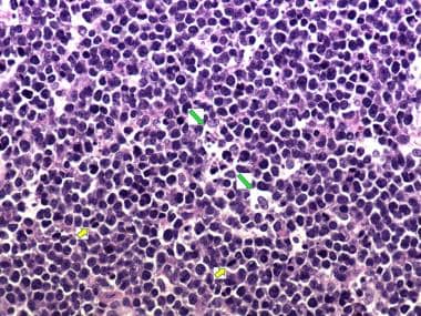 Burkitt lymphoma under high magnification showing 