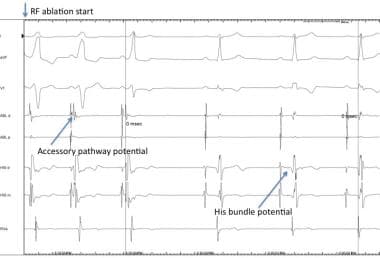 wolf parkinson syndrome ablation