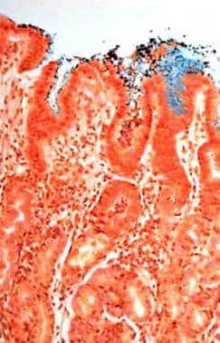 Atrophic gastritis. Helicobacter pylori–associated