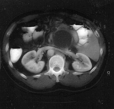 Contrast-enhanced CT scan of an infected pancreati