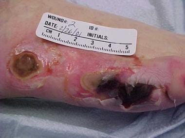 Bedsores (Pressure Ulcers) Condition, Treatments and Pictures for