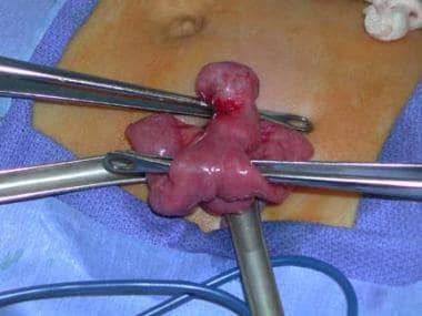 Intraoperative view of the bleeding Meckel diverti