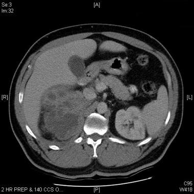 xanthogranulomatous pyelonephritis ultrasound