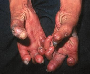 Leprosy: Background, Pathophysiology, Epidemiology