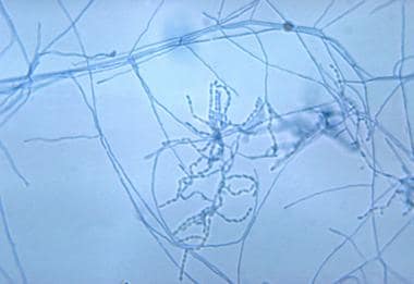 High-power microscopic appearance of Nocardia. Ima