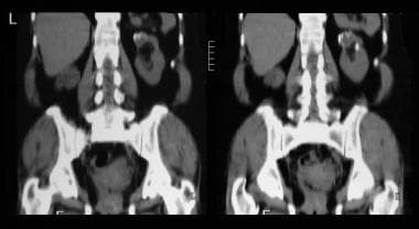 Nonenhanced coronal CT scans through kidneys, show