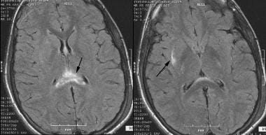 Closed Head Injury: Practice Essentials, Pathophysiology, Epidemiology