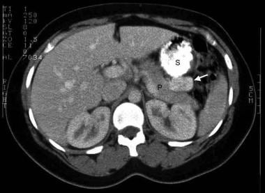 Neoplasms of the endocrine pancreas. CT scan image