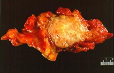 Pancreatic tumor