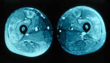 severe polymyositis