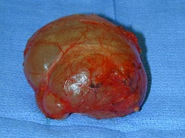 Spermatocele after complete excision. 