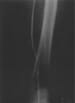 Lower-Extremity Arterial Occlusive Disease