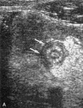 Transverse graded compression transabdominal sonog