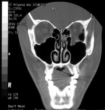 Left orbital floor fracture. This patient presente