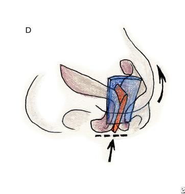 Rhinoplasty, tip ptosis. Rotation of the nasal tip