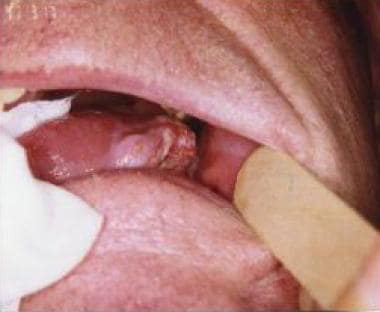 Clinical appearance of a lateral tongue squamous c