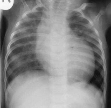 Endocardial Fibroelastosis. Chest radiograph, ante