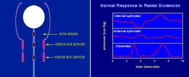 图像显示正常的肛门直肠测压