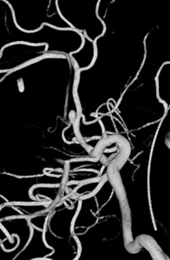 Three-dimensional reconstruction of cerebral angio