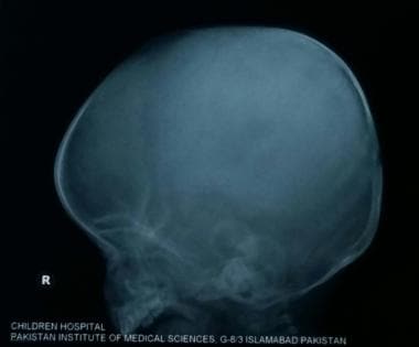Lateral view on skull radiograph of a 1-year-old b