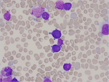 Multiple megakaryoblasts with cytoplasmic blebbing