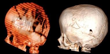 Bilateral coronal craniosynostosis repair. 3D rend