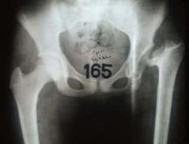 Sixth radiograph in series of septic left hip. At 
