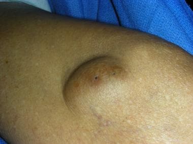 Subepidermal lesion: Keratinous cyst (epidermal in