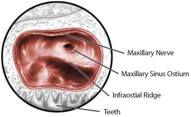 Schematic of intrasinus view of the medial maxilla