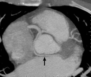 Anomalous left circumflex: Axial CT image of an an