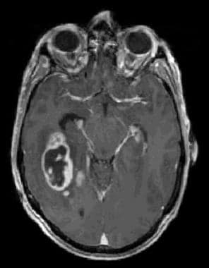 Contrast-enhanced T1-weighted magnetic resonance i