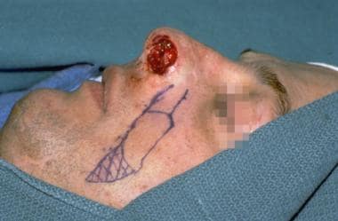 Case 5. Intraoperative design of superiorly based 