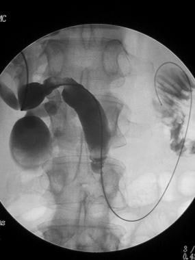 A stiff wire is advanced to the small bowel and us