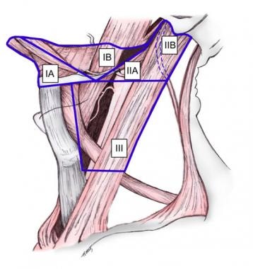 Supraomohyoid neck dissection. 