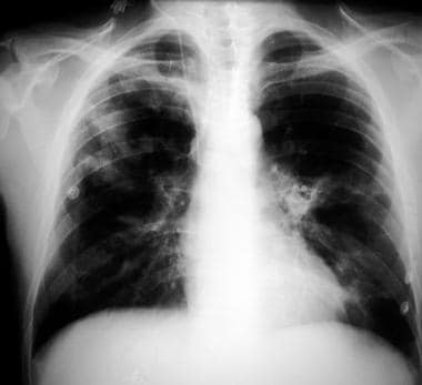 Chest radiograph in a patient with HIV infection a