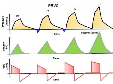 The pressure, volume, and flow to time waveforms f