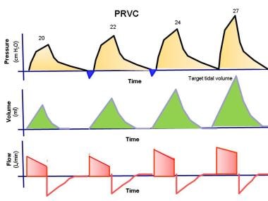 The pressure, volume, and flow to time waveforms f