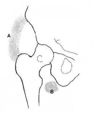 Three common locations of heterotopic ossification