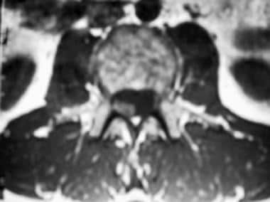 Axial T1-weighted MRI of the lumbar spine shows th