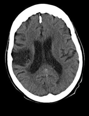 Chronic infarction: Noncontrast CT scan demonstrat