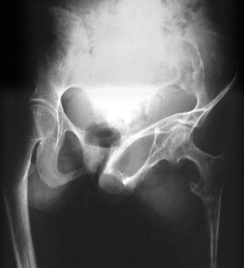 Plain radiograph of the pelvis in a 28-year-old wo