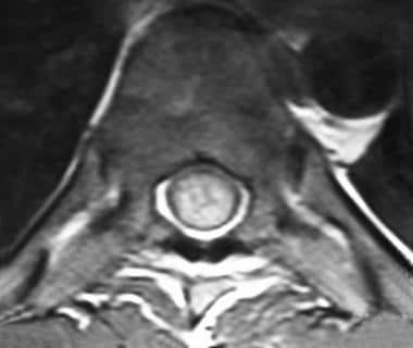 Axial T1-weighted image confirms the central locat