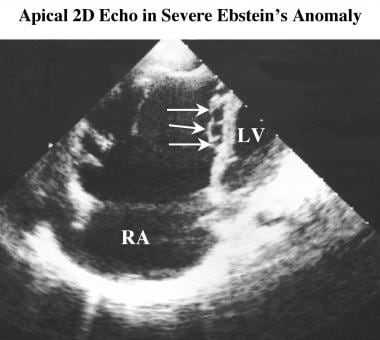 Apical 4-chamber image from 2-dimensional (2D) ech