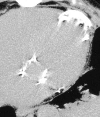 Non–contrast-enhanced CT of the patient seen in th