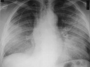 Frontal chest radiograph in a patient with the dif