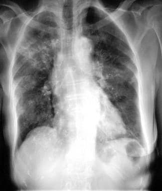 Chest radiograph in an 81-year-old woman with mitr